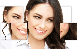 Acne treatment - Laser scar treatment in Madurai at GEM Skin, Hair and Laser Centre