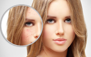 Scar - Best skin care clinic in Madurai at GEM Skin, Hair and Laser Centre