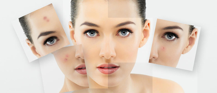 Acne treatment - Pimples removing treatment in Madurai at GEM Skin, Hair and Laser Centre