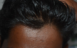 After Dandruff treatment in Madurai at GEM Skin, Hair and Laser Centre