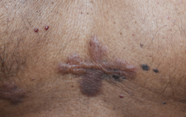 After Chicken scar treatment in Madurai at GEM Skin, Hair and Laser Centre