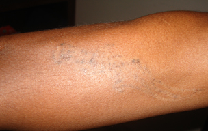After Tattoo reduction treatment in Madurai at GEM Skin, Hair and Laser Centre