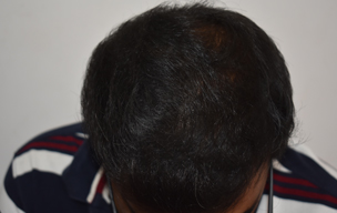 After Hair fall treatment in Madurai at GEM Skin, Hair and Laser Centre