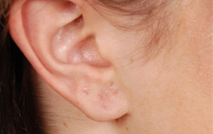 After Ear hole repair treatment in Madurai at GEM Skin, Hair and Laser Centre