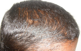 After Hair restoration treatment in Madurai at GEM Skin, Hair and Laser Centre