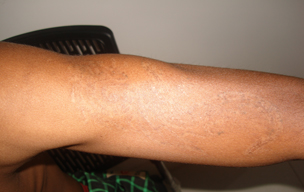After Tattoo removal treatment in Madurai at GEM Skin, Hair and Laser Centre
