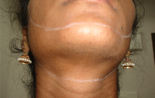After Body hair growth removal treatment in Madurai at GEM Skin, Hair and Laser Centre