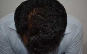After Hair loss treatment in Madurai at GEM Skin, Hair and Laser Centre