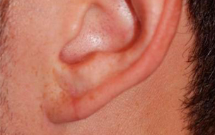 After Painless ear piercing in Madurai at GEM Skin, Hair and Laser Centre