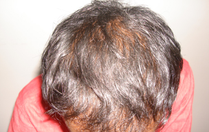 After Laser treatment for hair problems at GEM Skin, Hair and Laser Centre