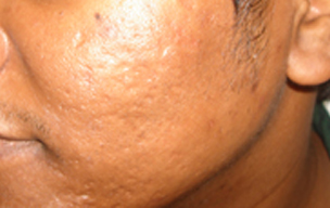After Laser scar treatment in Madurai at GEM Skin, Hair and Laser Centre
