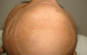 After Dandruff treatment in Madurai at GEM Skin, Hair and Laser Centre