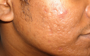 After Acne scar treatment in Madurai at GEM Skin, Hair and Laser Centre