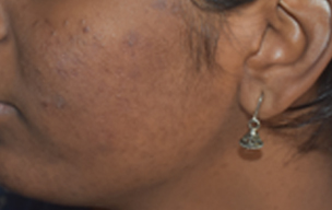 After Pimples removing treatment in Madurai at GEM Skin, Hair and Laser Centre