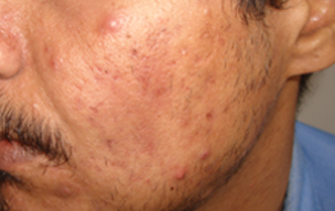 After Acne removing treatment in Madurai at GEM Skin, Hair and Laser Centre