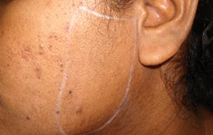 After Laser hair removal treatment in Madurai at GEM Skin, Hair and Laser Centre