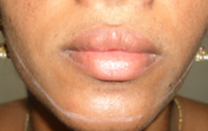 After Laser hair reduction treatment in Madurai at GEM Skin, Hair and Laser Centre