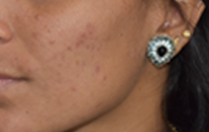 After Laser treatment for acne scars at GEM Skin, Hair and Laser Centre