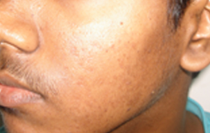 After Laser treatment for pimple at GEM Skin, Hair and Laser Centre