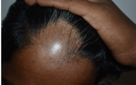 Before Dandruff treatment in Madurai at GEM Skin, Hair and Laser Centre