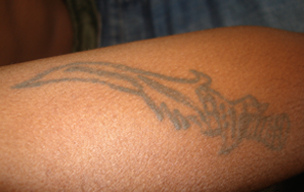 Before Tattoo reduction treatment in Madurai at GEM Skin, Hair and Laser Centre