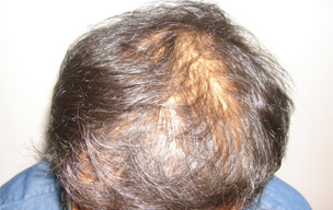 Before Hair fall treatment in Madurai at GEM Skin, Hair and Laser Centre
