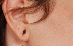 Before Ear hole repair treatment in Madurai at GEM Skin, Hair and Laser Centre