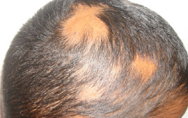 Before Hair restoration treatment in Madurai at GEM Skin, Hair and Laser Centre