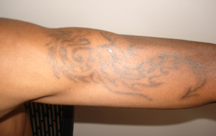 Before Tattoo removal treatment in Madurai at GEM Skin, Hair and Laser Centre