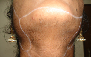 Before Body hair growth removal treatment in Madurai at GEM Skin, Hair and Laser Centre