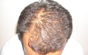 Before Hair loss treatment in Madurai at GEM Skin, Hair and Laser Centre