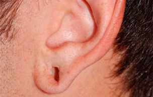 Before Painless ear piercing in Madurai at GEM Skin, Hair and Laser Centre
