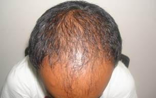 Before Laser treatment for hair problems at GEM Skin, Hair and Laser Centre