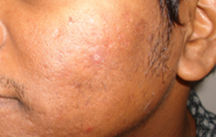 Before Acne scar treatment in Madurai at GEM Skin, Hair and Laser Centre