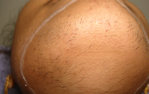 Before Dandruff treatment in Madurai at GEM Skin, Hair and Laser Centre