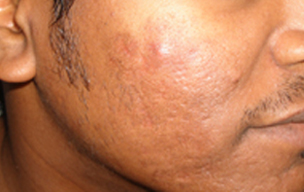 Before Chicken scar treatment in Madurai at GEM Skin, Hair and Laser Centre