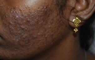 Before Pimples removing treatment in Madurai at GEM Skin, Hair and Laser Centre