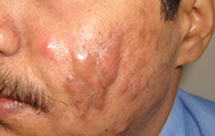 Before Acne removing treatment in Madurai at GEM Skin, Hair and Laser Centre