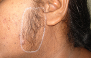 Before Laser hair removal treatment in Madurai at GEM Skin, Hair and Laser Centre