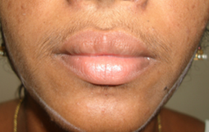 Before Laser hair reduction treatment in Madurai at GEM Skin, Hair and Laser Centre