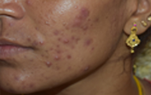 Before Laser treatment for acne scars at GEM Skin, Hair and Laser Centre