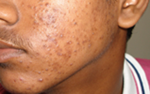 Before Laser treatment for pimple at GEM Skin, Hair and Laser Centre