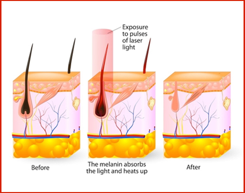 Laser hair reduction - Laser hair removal treatment in Madurai at GEM Skin, Hair and Laser Centre