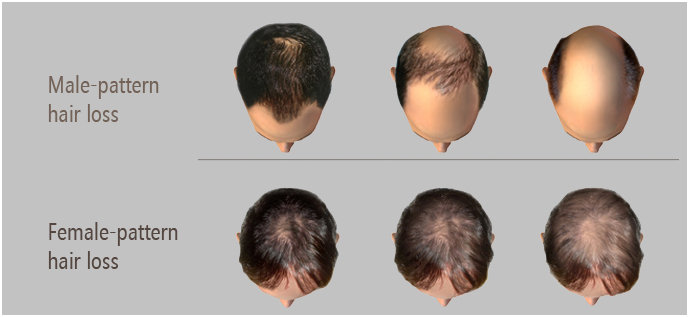 Male and female pattern hair loss - Dandruff treatment in Madurai at GEM Skin, Hair and Laser Centre