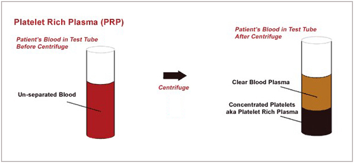 PRP - Laser treatment for hair problems at GEM Skin, Hair and Laser Centre
