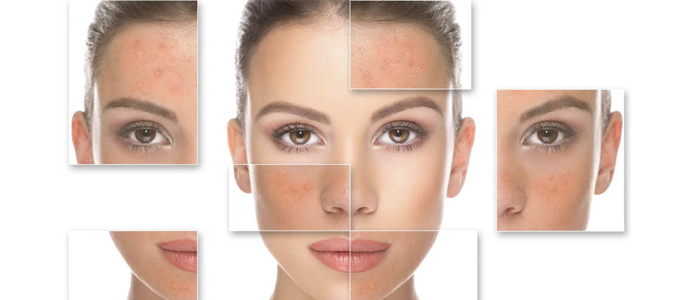 Laser scar treatment in Madurai at GEM Skin, Hair and Laser Centre