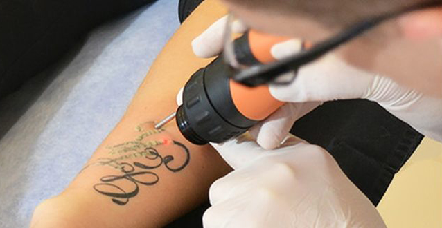 Tattoo removal - Tattoo reduction treatment in Madurai at GEM Skin, Hair and Laser Centre