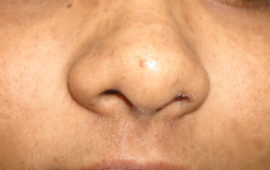 After Anti pigmentation treatment in Madurai at GEM Skin, Hair and Laser Centre