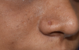 After Mole removing treatment in Madurai at GEM Skin, Hair and Laser Centre