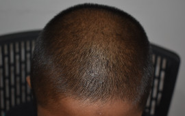 After Weight loss treatment in Madurai at GEM Skin, Hair and Laser Centre